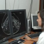 La importancia de la detección precoz del cáncer de mama